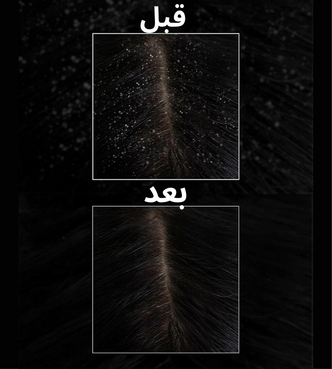 Bioxcin Aqua Thermal DS Anti-Dandruff Shampoo 200 ml